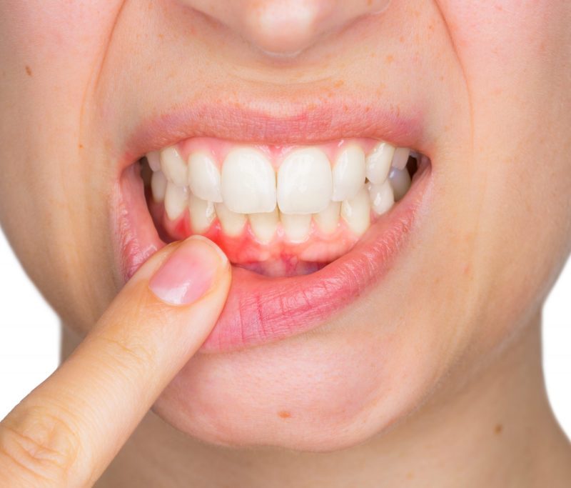 Close-up of swollen, red gums being examined as a common symptom of periodontal issues – how to know if you have gum disease