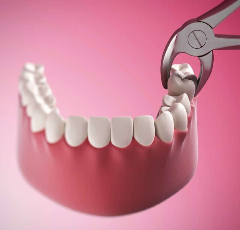 3D illustration of a tooth being removed from the jaw using dental forceps – how do you pull a tooth