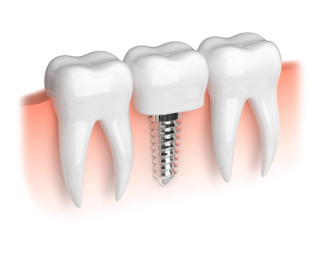 Essential Tips for Caring for Your Dental Implants