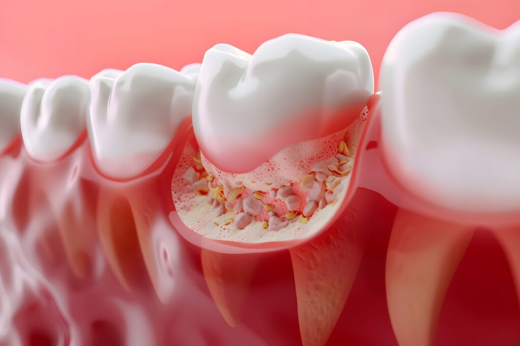 The Different Stages of Gum Disease