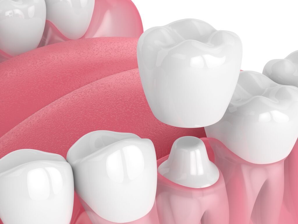 What Can I Do About Dental Crown Sensitivity?